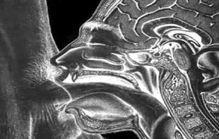 Обложка «Вафлизм» в подростковом возрасте